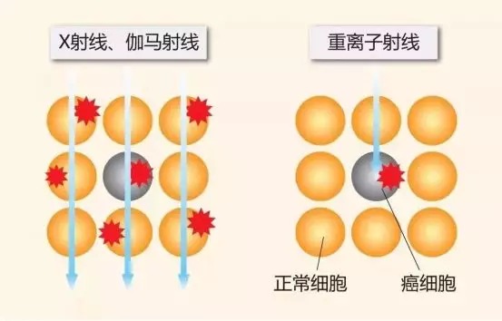 質(zhì)子重離子技術(shù)醫療險可以報銷(xiāo)嗎？
